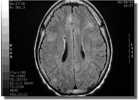 MRI scan