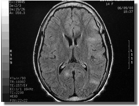 MRI scan