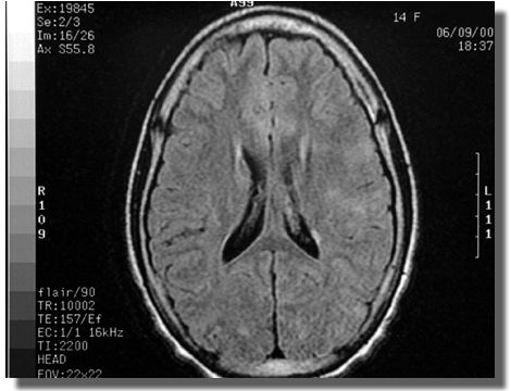 MRI scan
