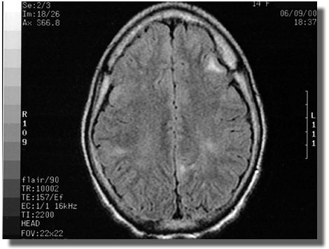 MRI scan