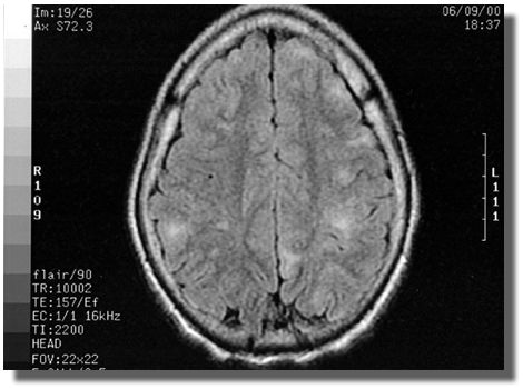 MRI scan