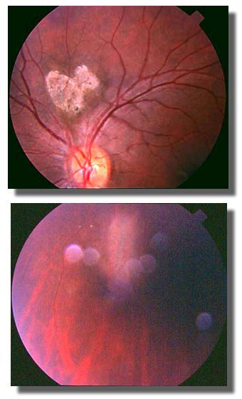 Superior and inferior lesions OS