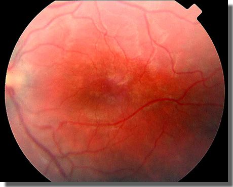 fundus image