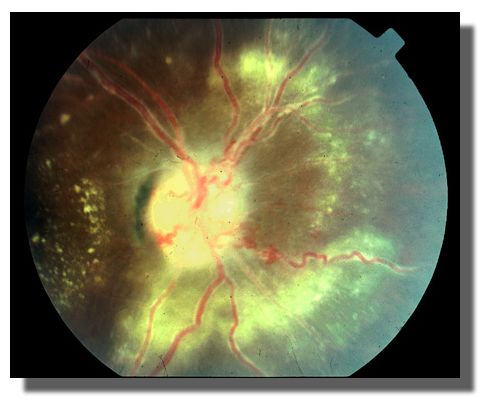 Optic nerve sarcoidosis