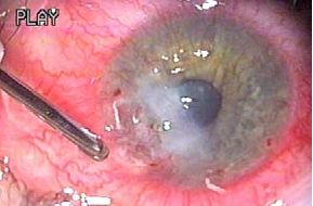 Cauterization