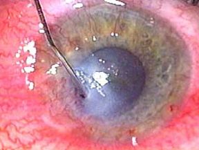 Reforming the anterior chamber