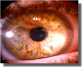 OD: outcome after keratoplasty