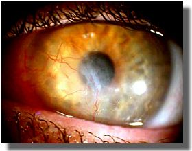OS: outcome after keratoplasty