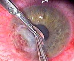 Positioning the patch graft