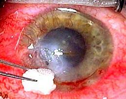 Removal of tissue adhesive