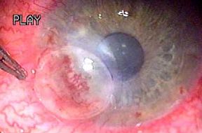 Patch graft