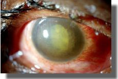 Appearance of cornea after treatment