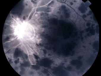 Fluorescein angiogram OS