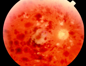 Fundus image OD