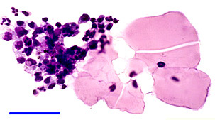Phagocytosis of lens material