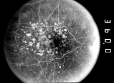 Fluorescein angiogram showing retinal circulation in age-relatd macular degeneration
