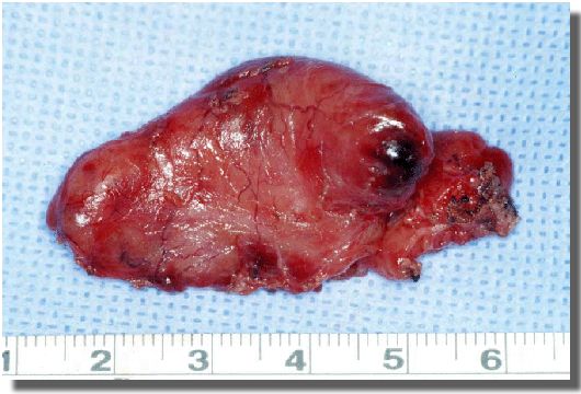 Tumor