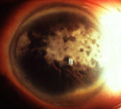 corneal degeneration