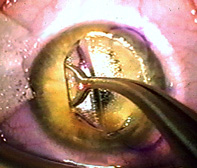 refractive surgery