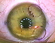 refractive surgery