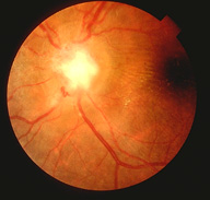 sarcoid granuloma of the optic nerve